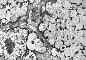 F, 75y. | skin metastasis of mucinous adenocarcinoma F, 75y. | skin metastasis of mucinous adenocarcinoma